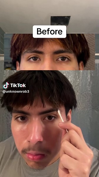 Minoxidil Day 19 Progress Update