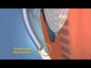 Closed Angle Glaucoma