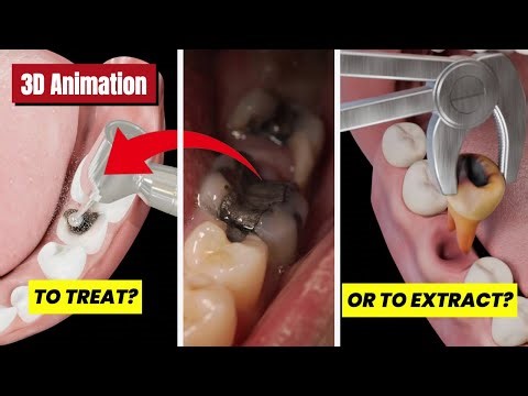 Tooth Cavity: To TREAT or EXTRACT? When Dentists Save vs Remove Your Tooth