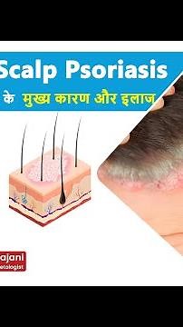 जानें क्या होता है Scalp Psoriasis और क्या है इसके होने के मुख्य कारण और इलाज | Dr.Jaspreet Rajani