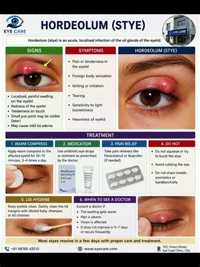 Stye, Sign symptoms and treatment✨ #shorts #viral #eye #eyecare #stye ‪@eye_carevi‬