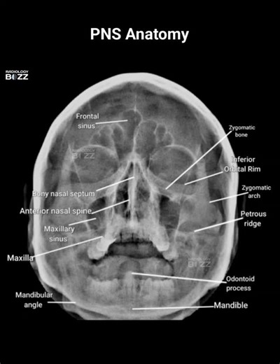 🩻✨ PNS View Anatomy — ✨👃 Here’s a beautifully labeled Paranasal Sinus (PNS) X-ray, showcasing the vital bony and sinus structures of the facial skeleton — a must-know for every radiology professionals! 💀📸 This view helps assess the frontal, maxillary, and ethmoidal sinuses, along with surrounding facial bones for sinusitis, fractures, or other pathologies 🧠 The PNS (Waters) view is obtained with the orbitomeatal line angled 37° to the detector — allowing clear visualization of the maxillary