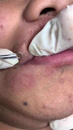 Facial Pore Extraction: Clinical Close-Up Procedure