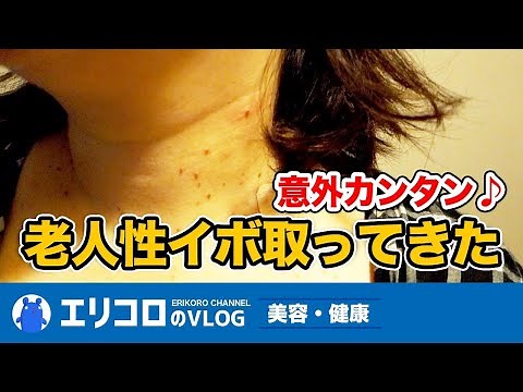 [Beauty for over 50s] The first installment of senile wart removal! I had some annoying senile wa...
