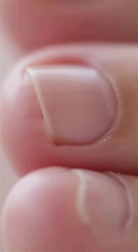 Tired of nail fungus that keeps coming back — no matter what you try? A leading dermatologist reveals 3 home strategies to block fungus at the root. 🍋 Natural 📋 Backed by real cases ✅ Works even after years of failed treatments Watch the free video and see what most people do wrong — and how to fix it starting today. | Dr Rossi