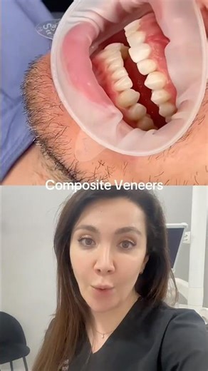 How Composite Bonding Can Work ?!