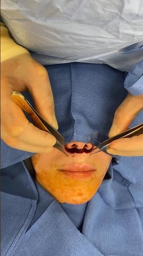 The power of a surgical Lip Lift