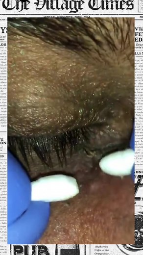 Explosion Acne no TikTok