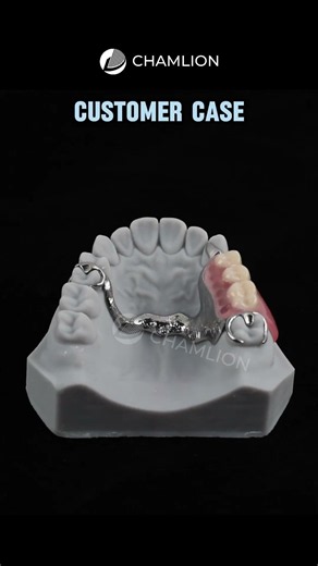 Why use metal 3D printing for RPDs?