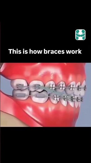 All you need to know about braces