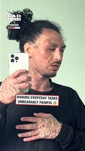 Battling topical steroid withdrawals 😲 (🎥: TT/ terimafive)