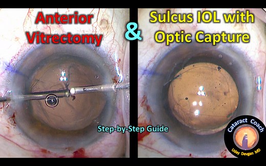 Anterior Vitrectomy & Sulcus IOL with Optic Capture