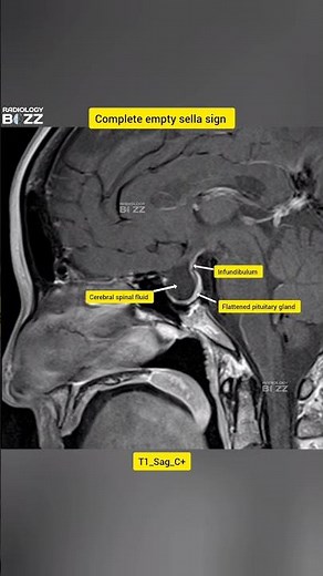 🧠 Empty Sella Syndrome #medicalimaging #radiologybuzz #anatomy