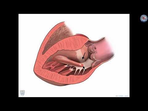 Surgical treatment for hypertrophic cardiomyopathy: A historical perspective