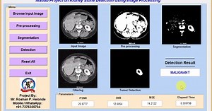 Kidney Stone Detection Using Image Processing Matlab Project Code