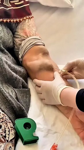 ADRIÁN SUÁREZ || Enfermero on Instagram: "Fístula arteriovenosa (FAV): Es una anastomosis quirúrgica entre una arteria y una vena superficial, habitualmente en la extremidad superior, creada para facilitar el acceso vascular en pacientes con enfermedad renal crónica en hemodiálisis. La FAV permite un flujo sanguíneo elevado y constante, fundamental para una depuración eficaz durante las sesiones. Su maduración suele requerir entre 4 y 8 semanas, periodo durante el cual la vena se arterializa, au