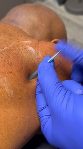 🏆 Dry needling uses a thin needle to target tight muscles and trigger points. It helps reduce pain, improve movement, and reset dysfunctional tissue patterns. Quick, precise, and effective. 🏋🏽‍♂️🏌🏻‍♀️🏃🏾‍♂️ #DryNeedling #MuscleRelease #ChicagoChiropractor | Dr_kyleross