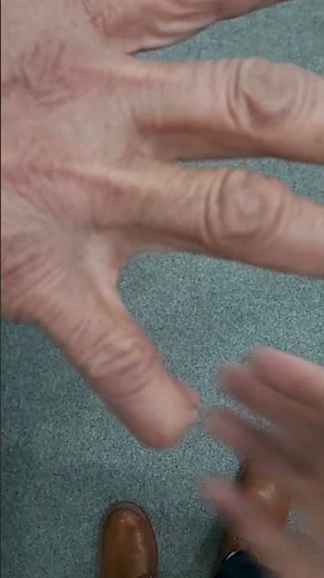 Heberden's nodes | Osteoarthrites DIP joints