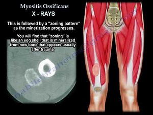 Myositis Ossificans: Causes, Diagnosis, Imaging, and Treatment • Video • MEDtube.net