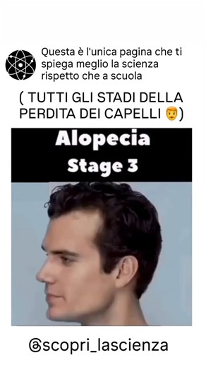 Esperimenti e dimostrazioni 🔬🧑‍🔬 on Instagram: "L’alopecia areata non segue stadi fissi di progressione: ciò che accade è un’interruzione del ciclo naturale di crescita dei fili. I follicoli piliferi entrano prematuramente nella fase di riposo, determinando zone arrotondate e senza capelli** sul cuoio capelluto o in altre parti del corpo. Con il tempo questi difetti possono aumentare, unirsi o moltiplicarsi e in casi più gravi portare alla perdita totale dei fili della testa (alopecia totale)