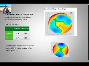 Simple Guide to Corneal Topography & Pentacam ( follow for more at quickguide.org)