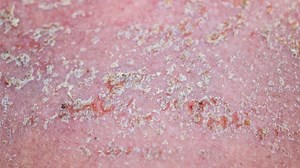 Mengenal Perbedaan Dermatitis Seboroik dan Psoriasis