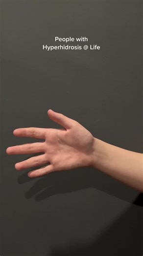 How would you rate your sweating severity?😕 We all know sweaty palms and feet can be frustrating or embarrassing at times. ✋🏻🦶🏻💧Let's give a shoutout to those who don't judge and truly accept who you are! 💚Did you know sweaty hands can be a medical condition known as palmer #hyperhidrosis?