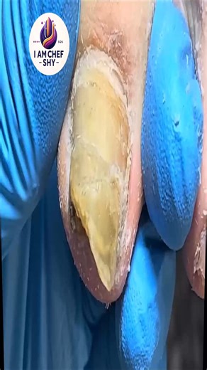 6K views · 38 reactions | Smart brittle toenail tips that suit diabetic feet ♥️ #FootWellnessUSA #EverydayCare #SafeSteps | I am Chef Shy | Facebook