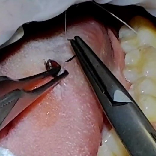Punch Biopsy of Left Ventral Tongue for Leukoplakia