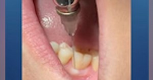 First and second molar Septocaine infiltration demo
