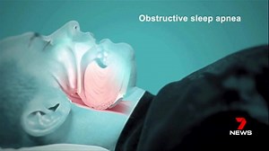 112K views · 631 reactions | UPDATE: The sleep surgery trial is full and applications have now closed. EARLIER -- The search for an effective cure for snoring might finally be over. If you have sleep apnoea, doctors are recruiting for a research trial where volunteers will have costs covered, including for the surgery, if other treatments fail. You can register your interest here: https://www.aishresearch.com/ #7News | 7NEWS Melbourne | Facebook