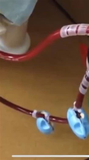 What is ECMO line chatter and why does it matter?? Line chatter refers to visible vibration or “shaking” of the ECMO drainage cannula. It’s typically caused by excessive negative pressure at the drainage site, often due to: • Hypovolemia • Cannula malposition • Obstruction or kinking in the tubing • High pump speeds relative to preload Persistent chatter can compromise flow and/or increase risk of hemolysis. . Check out the ADVANCED ICU BUNDLE and the other Nurse Dose Cheat Sheets/Resources in t