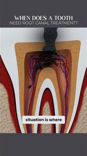 When does a tooth need root canal treatment?