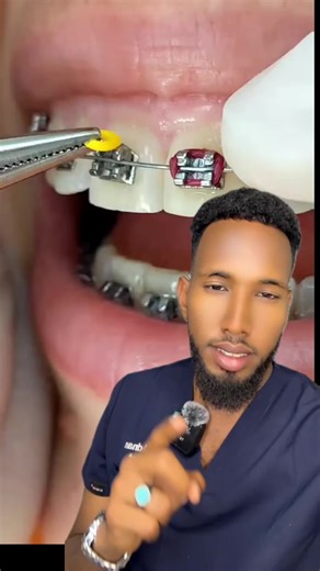 Invisalign Braces: Benefits and Insights from Experts