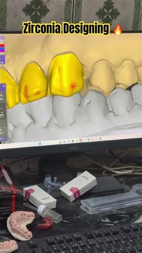 #dental #3dprinting #dentalcaddesign #dentalclinic #exocad #osstem #dentium #likesharesubscribe