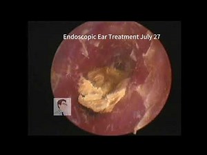 ear wax removal 20230727