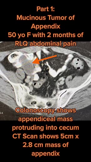 #roboticsurgery#appendectomy