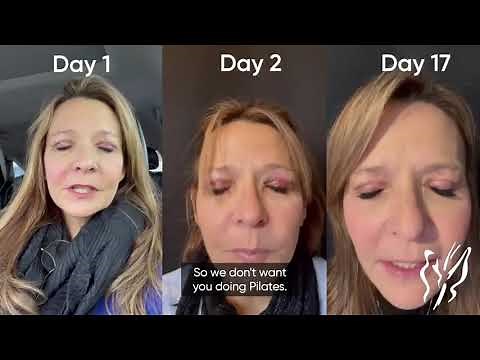 The Surprisingly Easy Recovery Process of Upper Eyelid Surgery - Best Cosmetic Eyelids 2023