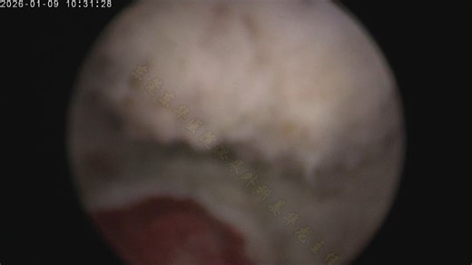 激光微创，亦是精细的艺术