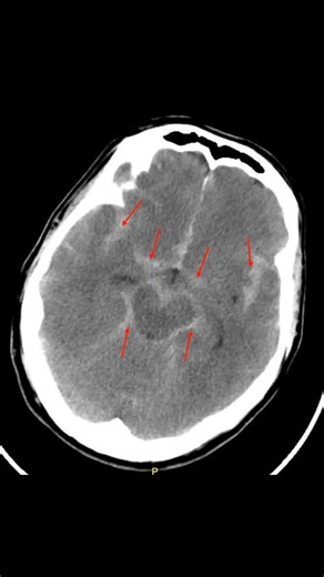 Medical Education on Instagram: "On CT imaging, a subarachnoid hemorrhage (SAH) appears as hyperdense blood within the subarachnoid spaces, often most prominent in the basal cisterns, sulci, and along the brain convexities. In cases of anterior communicating artery aneurysm rupture, the “star sign” may be seen, characterized by hyperdensity radiating symmetrically from the basal cisterns, resembling a star. CT is highly sensitive in the first 24 hours, allowing rapid diagnosis and assessment of
