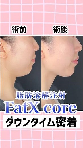 【脂肪溶解注射】FatX Coreのダウンタイム密着！ #shorts