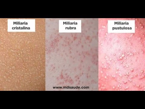 Miliaria crystallina, Miliaria Pustulosa and Miliaria rubra heat rash; sudamina, prickly heat