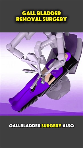 Gall Bladder Removal Surgery Explained with 3D Animation