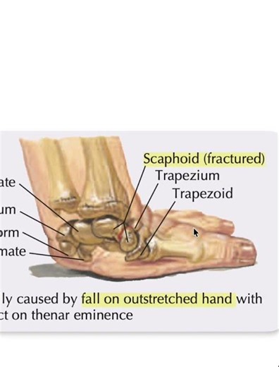 Scaphoid fracture #doctor #medicalstudent #anatomy