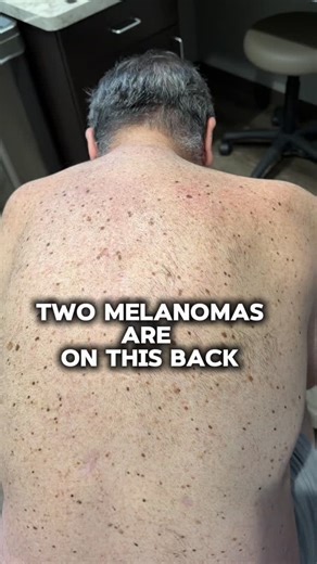 27K views · 164 reactions | Two melanomas. One back. This patient...