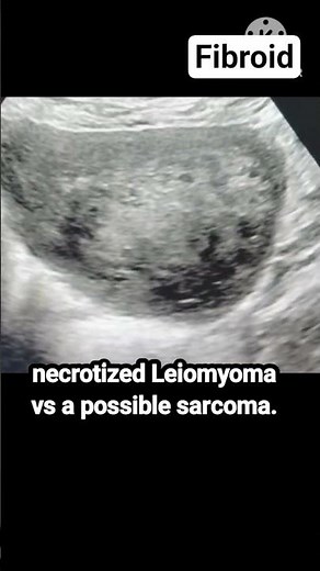 Degenerative fibroid on ultrasound #ultrasound