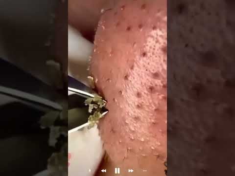 Skincare | Blackheads Removal #753 #tweezers skincare #blackheads blackheads