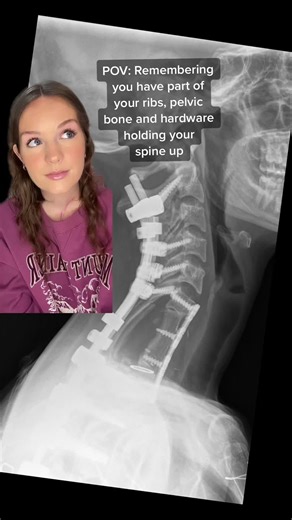 Understanding Spine Surgery Recovery: A Comprehensive Guide