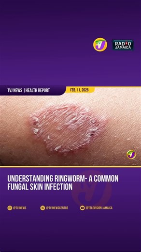 Our Dermatologist, Dr. Llorenia Muir Green, recently highlighted on TVJ Health Report that ringworm (Tinea Corporis) is a common and highly contagious fungal skin infection — especially among children. It spreads through direct contact and may be more severe in individuals with weakened immune systems. Mild cases are usually treatable with antifungal creams; however, persistent or widespread infections should be evaluated by a medical professional. 🎥 via @tvjnews When in doubt, get it checked. 