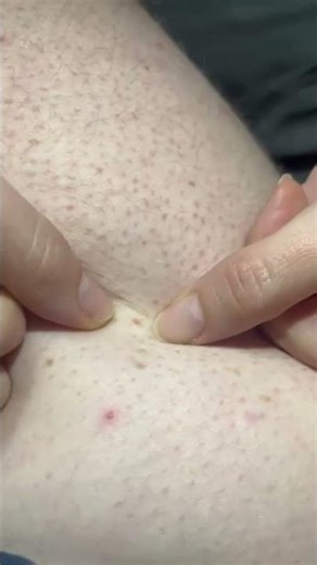 You’re going to want to turn the volume up for this one☝🏼 #pimplepopping #zitpopping #skincare